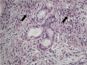 H&E staining showing lymphoplasmacytic infiltrates in pancreatic parenchyma