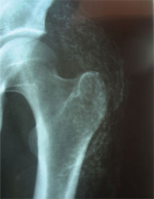 Radiografía simple de pelvis: lesiones micronodulares radiopacas confluentes compatibles con calcificaciones generalizadas en tejidos blandos.