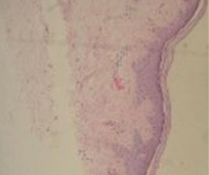 Biopsia de piel: dorso de mano derecha: epidermis normal con fibras de colágeno de características y distribución normal, algunas telangiectasias en dermis superficial.