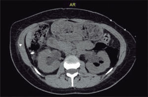 Escanografía de abdomen simple: moderada hidronefrosis bilateral, con dilatación ureteral que se extiende hasta tercio medio de uréteres, masa periaórtica distal a los hilios renales.