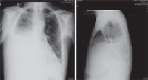 Radiografías de tórax proyecciones PA y lateral, en las que se observa radioopacidad completa de los dos tercios inferiores del hemitórax derecho con borramiento del contorno diafragmático y cardiaco de este lado y desviación del cardiomediastino hacia la izquierda, por derrame pleural. Mala definición del ángulo costofrénico lateral izquierdo probablemente por escaso derrame pleural de este lado.