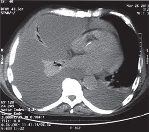 TAC de tórax: se observan derrames pleurales libres bilaterales, más extenso del lado derecho, con atelectasia del parénquima pulmonar adyacente. Se observa derrame pericárdico.