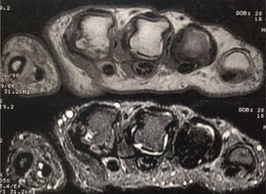 Imágenes axiales de RM ponderadas en T1 y en supresión de grasa en la que se visualiza líquido intraarticular de las metacarpofalángicas del segundo y tercer dedos. Hay edema óseo y erosión en aspecto radial de la cabeza del segundo metacarpiano.