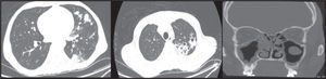 Tomografía de alta resolución de tórax (izquierda y centro) y tomografía de senos paranasales (derecha).