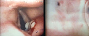 Fibrobroncoscopia. Izquierda: lesión blanquecina en comisura posterior del pliegue vocal derecho. Derecha: estenosis de tipo diafragma en el subsegmento del segmento posterior del lóbulo posterior izquierdo.