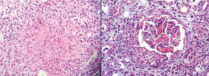 Estudio histopatológico renal. Izquierda: granuloma (hematoxilina-eosina 400×). Derecha: semiluna y necrosis (tricrómico 400×).