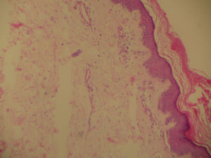 Biopsia de piel: hiperqueratosis, paraqueratosis, infiltrado linfocítico perivascular asociado a daño focal vacuolar de la basal. HE 100×.