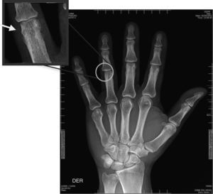 Neoformación ósea perióstica en metáfisis distal de interfalángica proximal, cuarto dedo de la mano derecha de uno de los pacientes del estudio.