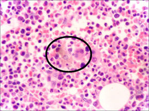 (Caso n.o 1). Tinción con hematoxilina/eosina 40×: médula ósea en donde se observa la presencia de hemofagocitois (círculo).
