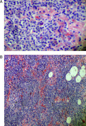 A) Acúmulos de material amiloide en ganglio linfático. Microscopia óptica, tinción rojo Congo 10 ×. B) Pérdida de la arquitectura normal del tejido linfoide. Microscopia óptica, tinción rojo Congo 4 ×.