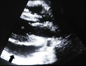 Ecocardiograma transtorácico modo bidimensional. Eje paraesternal largo: se observa abundante derrame pericárdico y colapso ventricular derecho (flecha).