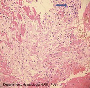 Biopsia pericardio: estroma de tejido fibroconectivo, inflamación aguda (flecha) y fibrina. (10x) Tinción H-E. EP.