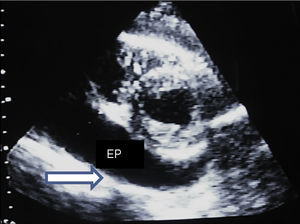 Ecocardiograma transtorácico, evidencia de abundante derrame pericárdico en hoja posterior. (EP).