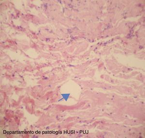 Biopsia de pericardio: estroma de tejido fibroconectivo (flecha). Cambios de inflamación crónica y calcificaciones incipientes con tejido reparativo. Infiltración linfocitaria. Tinción H-E (10x).
