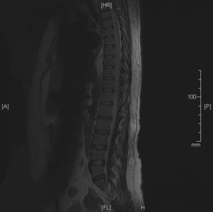 Resonancia magnética nuclear de médula espinal torácica y lumbar en secuencia T1, donde podemos observar el ensanchamiento medular en toda su extensión.
