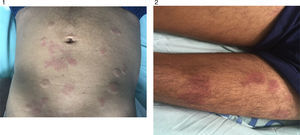 Lesiones en piel de abdomen y piernas, tipo habón, de coloración violácea, no pruriginosas, algunas coalescentes que forman placas.