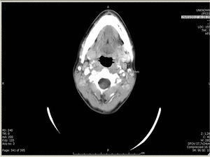 TAC cervical: se observan múltiples adenomegalias subcentrimétricas bilaterales.