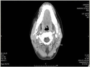 TAC de abdomen y pelvis: adenomegalias retroperitoneales.