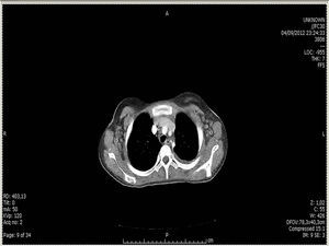 TAC de tórax: pérdida de volumen y tracto fibroatelectásico locales, derrame pleural laminar y adenomegalias axilares bilaterales.
