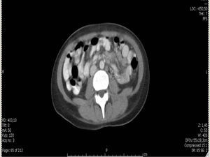 TAC de abdomen; adenomegalias paraaórticas.