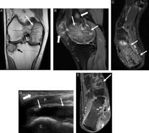 A y B) Secuencias de RM en planos coronal Dp y sagital T2 Fat-Sat de la rodilla derecha. Lesiones óseas en cóndilo femoral interno (flechas finas blancas en A y B) y meseta tibial externa (flecha negra en A), ambas rodeadas por un margen serpinginoso hipointenso en Dp, sugestivas de infartos. Se observan otras 2 lesiones más pequeñas en diáfisis distal del fémur y tercio inferior de la rótula (flechas blancas gruesas en B). Las lesiones presentan patrón medular mixto «granular» consistente en edema y saponificación grasa. Alrededor de las lesiones descritas se observa edema medular reactivo. C) Secuencia de RM en plano axial T2 Fat-Sat del pie derecho. Se aprecia lesión extensa medular en el calcáneo con las mismas características que las otras lesiones descritas (flechas). D) Corte longitudinal ecográfico del tobillo derecho: colección líquida (flechas) posterior a los tendones peroneos, de mayor tamaño y con más ecos internos que en el tobillo izquierdo (no mostrada). Edema del tejido celular subcutáneo (flechas gruesas) compatible con paniculitis. E) Secuencia de RM en plano axial T1 tras la administración de contraste del tobillo izquierdo: área de necrosis medular ósea en cuña lateral con realce periférico (flecha larga), disrupción de la cortical ósea del calcáneo con formación cistoidea multiloculada adyacente (flechas cortas) y edema de tejidos blandos retroperoneos sugestivo de paniculitis. C: calcáneo; P: tendones peroneos.