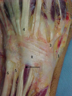 Anatomía del retináculo de los tendones extensores (R) con sus compartimentos. 1: primer compartimento extensor; 2: compartimento para los extensores radiales largo y corto del carpo; 3: para el extensor largo del pulgar; 4: para el extensor común de los dedos y propio del 2.°; 5: para el extensor propio del 5.° dedo; 6: para el extensor cubital del carpo. Con flecha se señala la sinovial que rodea a los tendones.