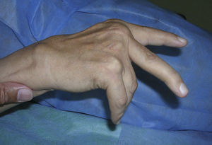 Paciente con caput ulnae con imposibilidad para hacer extensión por rotura de los tendones extensores del 4.° y 5.° dedo.