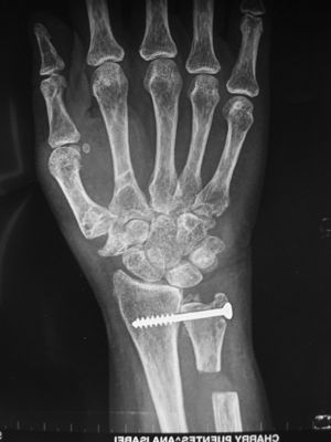 Resultado radiológico de una artrodesis radiocubital distal con seudoartrosis proximal en el cúbito (técnica de Sauve-Kapandji).