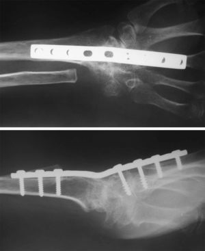 Resultado de una artrodesis radiocarpiana con fusión total. Además se realizó resección del extremo distal del cúbito (técnica de Darrach).
