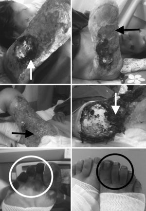 Evolución gráfica de las lesiones en piel. Flecha blanca: gangrena; flecha negra: úlcera; círculo blanco: necrosis; círculo negro: isquemia digital.