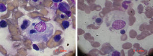 Dos fotos del aspirado de médula ósea del paciente número 3 se muestran con elementos sanguíneos siendo hemofagocitados.