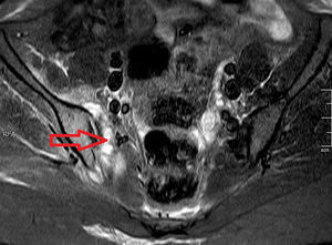 Resonancia magnética nuclear simple con secuencia de inversión-recuperación (STIR) de sacroilíacas. La flecha muestra los cambios inflamatorios de tejidos blandos periarticulares.