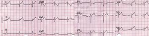 EKG de 12 derivaciones. Supradesnivel cóncavo del ST en cara inferior y lateral. Supradesnivel del PR en aVR.