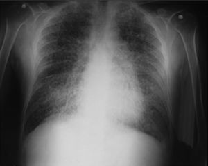 Radiografía tórax con partículas de arena en ambos campos pulmonares.