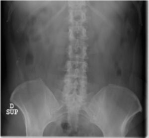 Véase alteración en la transición vertebral lumbosacra con una lumbarización sacra y aumento de ambas apófisis transversas de L5, más acusada en el lado derecho.
