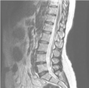 En la resonancia magnética nuclear se pone de manifiesto un cierto grado de deshidrataciones discales con moderadas salidas difusas de anillos fibrosos de discos intervertebrales L4-L5 y L5-S1 con pequeño desgarro anular posterior a nivel L5-S1. También presenta fenómenos degenerativos interapofisarios, que ocasionan disminución de calibre de forámenes a nivel L4-L5 y L5-S1, de mayor entidad a nivel L4-L5 derecho.