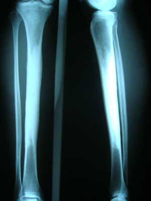 Radiografía AP y lateral de tibia y peroné que muestran gran fenómeno esclerótico en diáfisis en ambos huesos de manera simétrica.