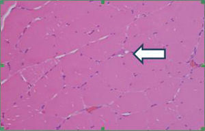 Presencia de células de aspecto linfoide endomisiales (flecha). Coloración hematoxilina-eosina. Aumento 40X.