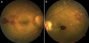 (a) Funduscopy right eye in which you can see papilledema with blurring of boundaries, subretinal hemorrhage, cotton wool spots and macular edema. (b) Funduscopy left eye in which hemorrhage and macular edema is observed, cotton wool spots and hemorrhage subretinal.