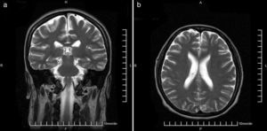 (a) Magnetic resonance imaging of the brain, T2 sequence coronal plane, within normal parameters. (b). Magnetic resonance imaging of the brain, T2 sequence transverse plane, within normal parameters.