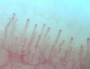 Videocapilaroscopia del lecho ungular con patrón normal, con capilares en forma de «peine» en cada papila dérmica (aumento 200x). Capilaroscopio Optilia. Servicio de Capilaroscopia. Clínica Universitaria Bolivariana.