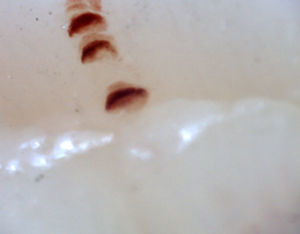 Presencia de hemorragia en «fumarola» en un patrón activo de esclerosis sistémica. Capilaroscopio Optilia. Aumento 200x. Servicio de Capilaroscopia Clínica Universitaria Bolivariana.