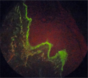 Inmnunofluorescencia en biopsia cutánea positiva Ig M en patrón de membrana fuerte y continuo.