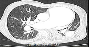 Vista axial de angio-TAC de tórax.
