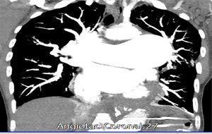 Vista coronal de angio-TAC de tórax. Dilatación de las ramas de la arteria pulmonar la cual alcanza un diámetro de 73mm a nivel de su tronco de salida. Hay gran dilatación aneurismática de la porción descendente cuyo diámetro en AP es de 40mm con formación de un gran trombo mural y asociada se encuentra una imagen lineal hipodensa que corresponde a disección de la arteria pulmonar.