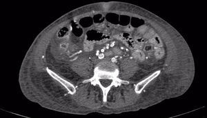 Cortes axiales en donde se visualizan a nivel de la aorta abdominal y sus ramas lesiones hiperdensas difusas compatibles con depósitos de calcio.