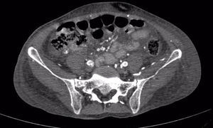 Cortes axiales en donde se visualizan a nivel de la aorta abdominal y sus ramas lesiones hiperdensas difusas compatibles con depósitos de calcio.