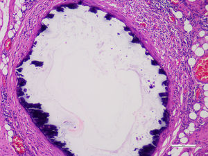 Se observa micrografía de una pared arterial con placa aterosclerótica de calcio (color violeta, tinción hematoxilina-eosina).