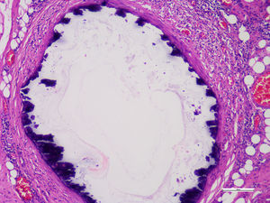 Se observa micrografía de una pared arterial con placa aterosclerótica de calcio (color violeta, tinción hematoxilina-eosina).
