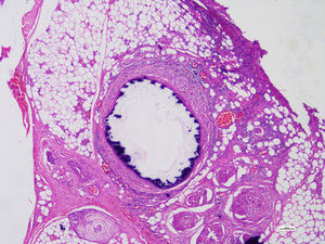 Cortes de vasos y células musculares lisas de la capa media, reemplazadas focalmente por tejido fibroso hialinizado que presentaba calcificación distrófica concéntrica.
